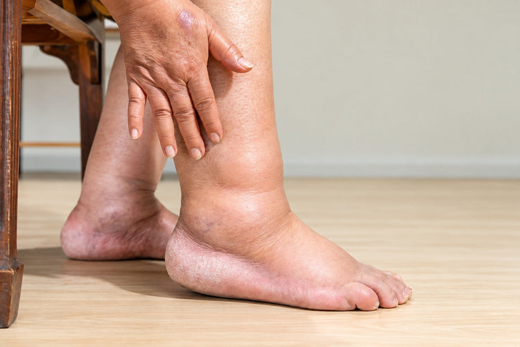 Swelling