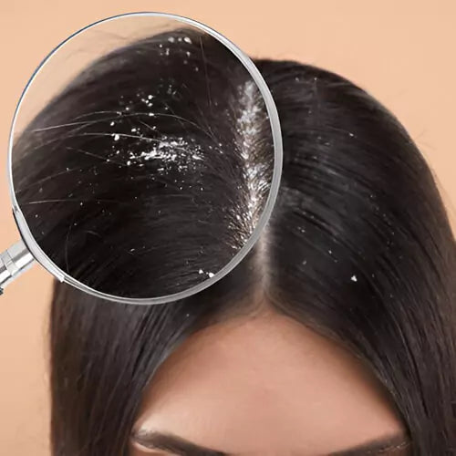 Dandruff